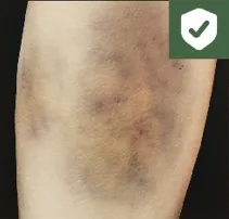 Bruises symptom