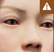 Conjunctivitis symptom