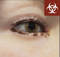 Eye pus symptom