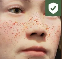 Freckles symptom