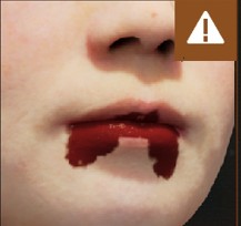 Mouth blood symptom