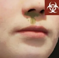 Nose pus symptom
