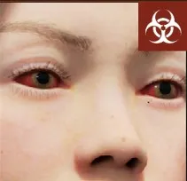 Red eyes symptom