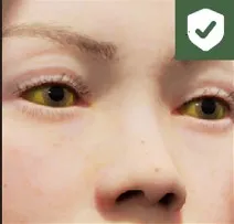 Yellow eyes symptom